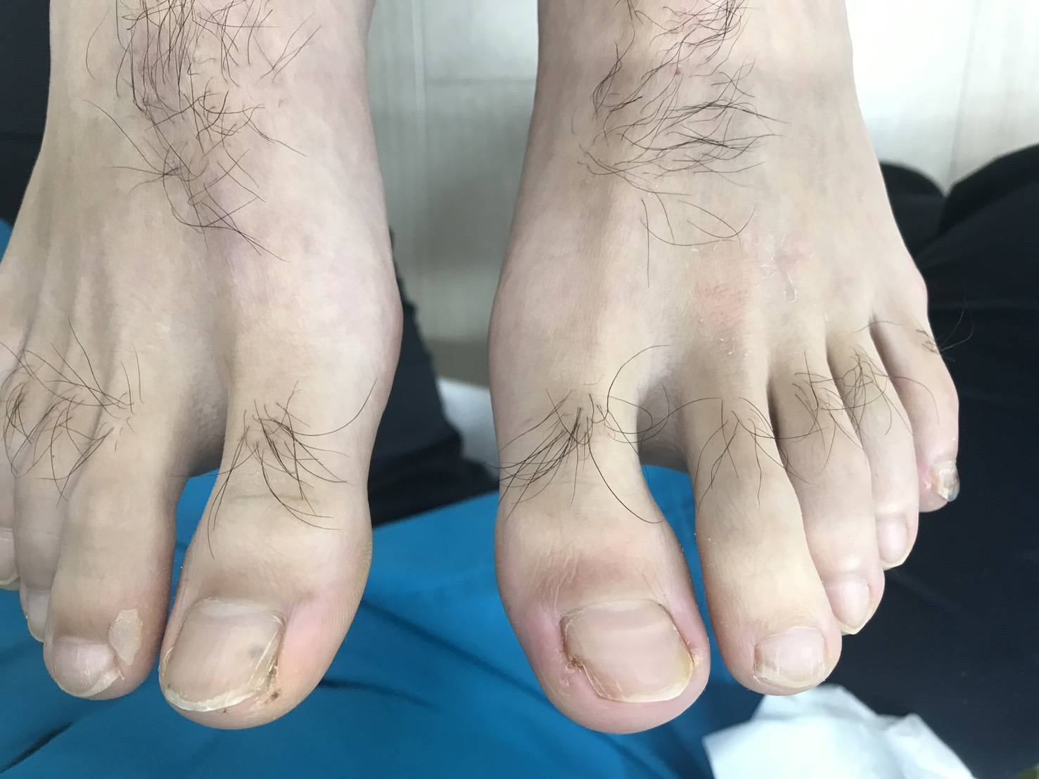 施術前陥入爪