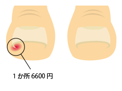 巻き爪1か所