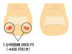 通常の爪